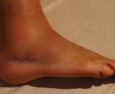 ankle sprain recovery