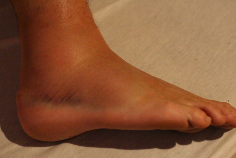 how to heal a sprained ankle overnight